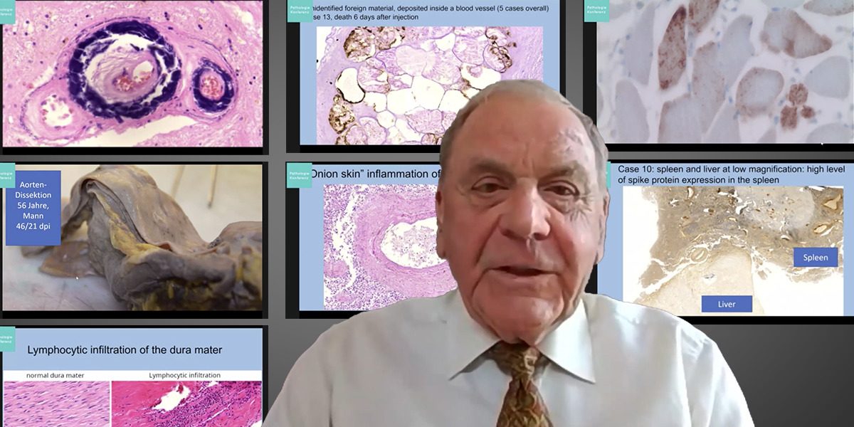 patho Pathologie-Konferenz: Impfinduzierte Spike-Produktion in Gehirn u.a. Organen nun erwiesen