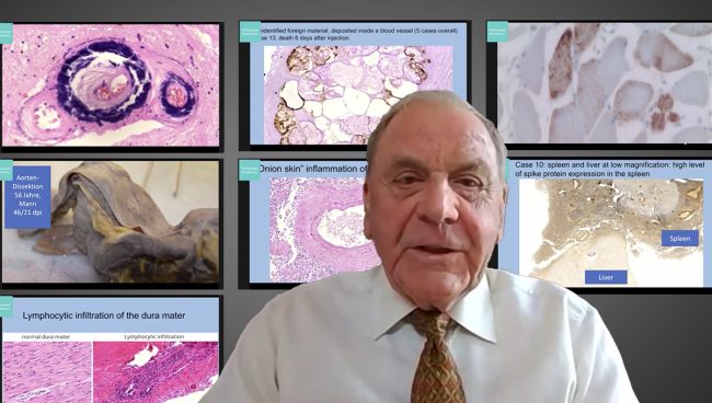 Pathologie-Konferenz: Impfinduzierte Spike-Produktion in Gehirn u.a. Organen nun erwiesen